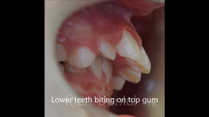 Crooked and protruding teeth fixed by functional appliance